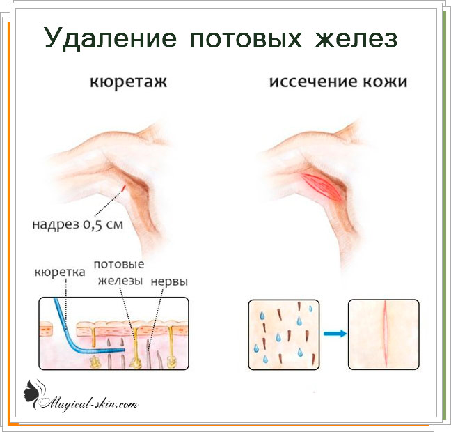 видалення залоз