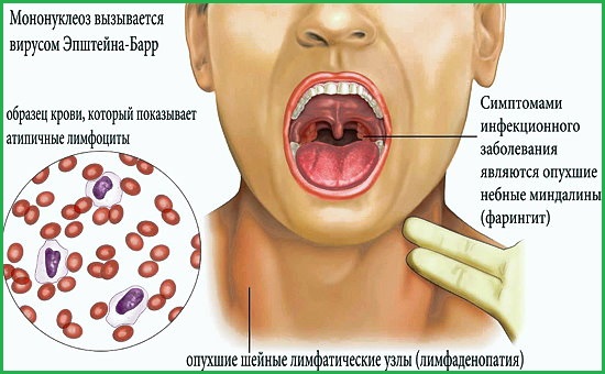 ознаки мононуклеозу