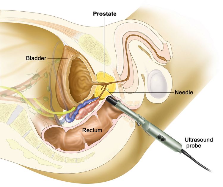 Як роблять ТРУЗІ передміхурової залози? підготовка