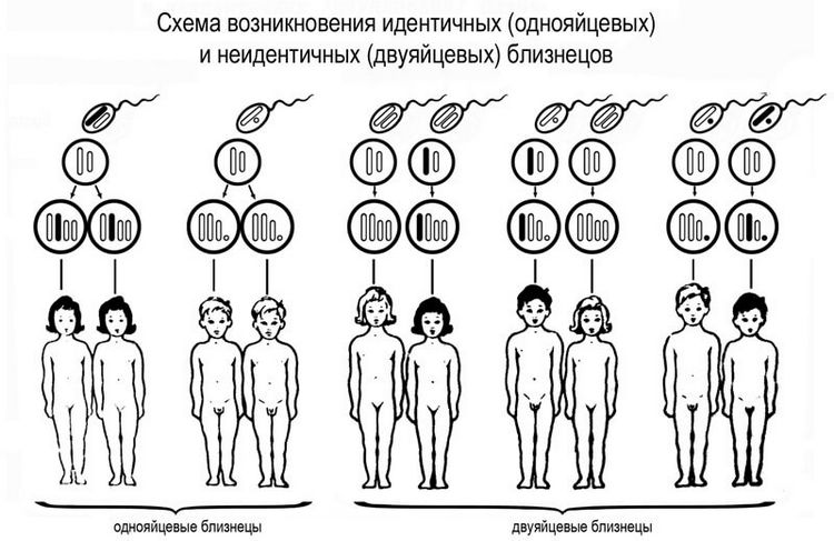 Що таке монохориальная діамніотіческая двійня?