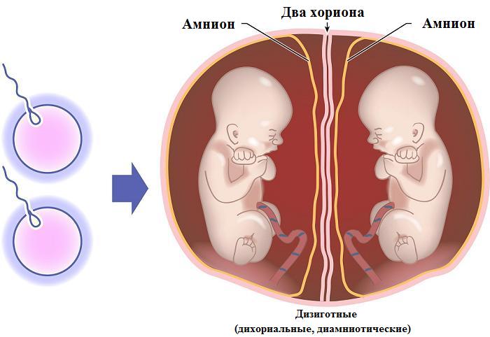 Що таке монохориальная діамніотіческая двійня?