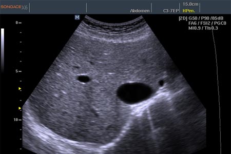 УЗД печінки: підготовка до процедури